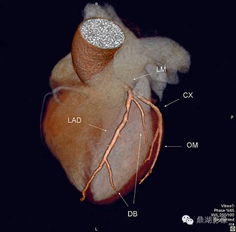 一篇文章解决冠脉CTA，赶紧收藏！