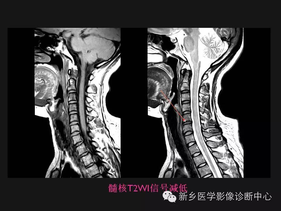 纯干货：颈椎病影像诊断重点汇总！