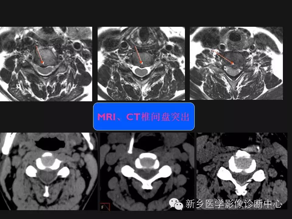 纯干货：颈椎病影像诊断重点汇总！