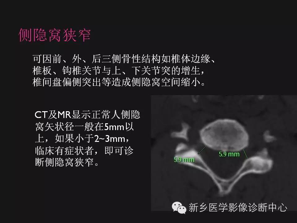 纯干货：颈椎病影像诊断重点汇总！