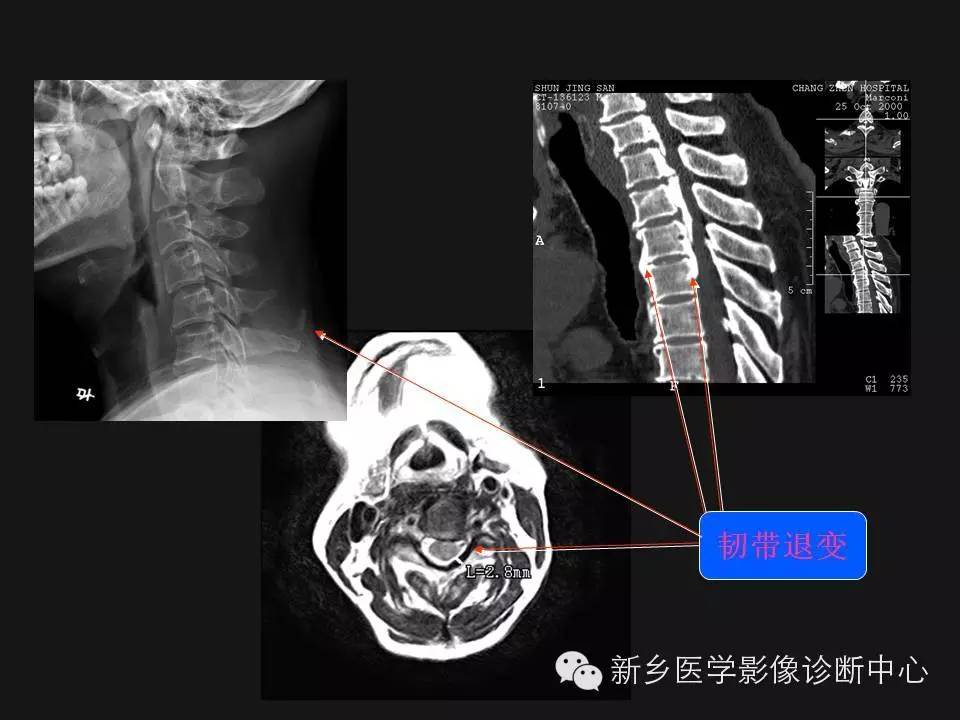 纯干货：颈椎病影像诊断重点汇总！