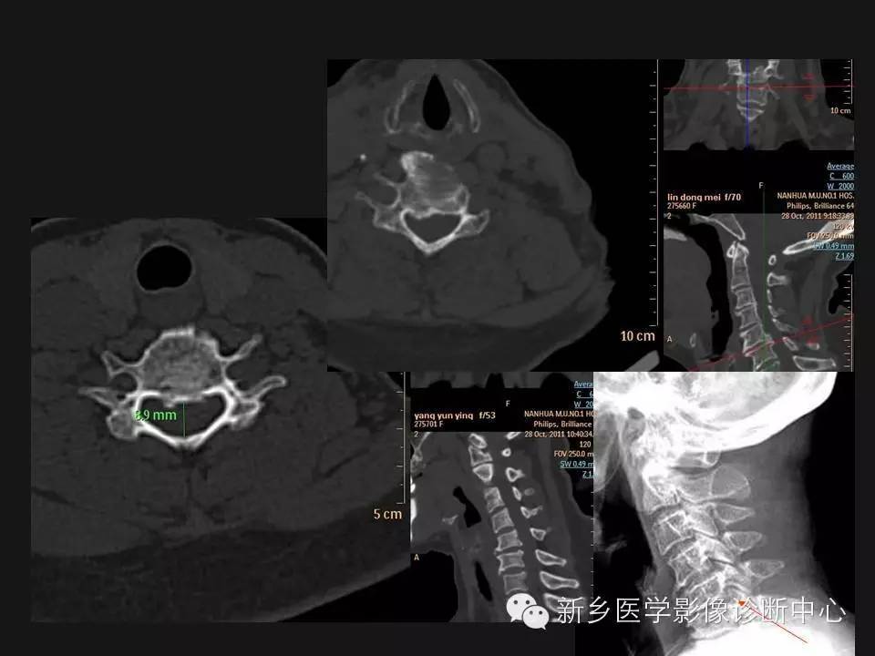 纯干货：颈椎病影像诊断重点汇总！
