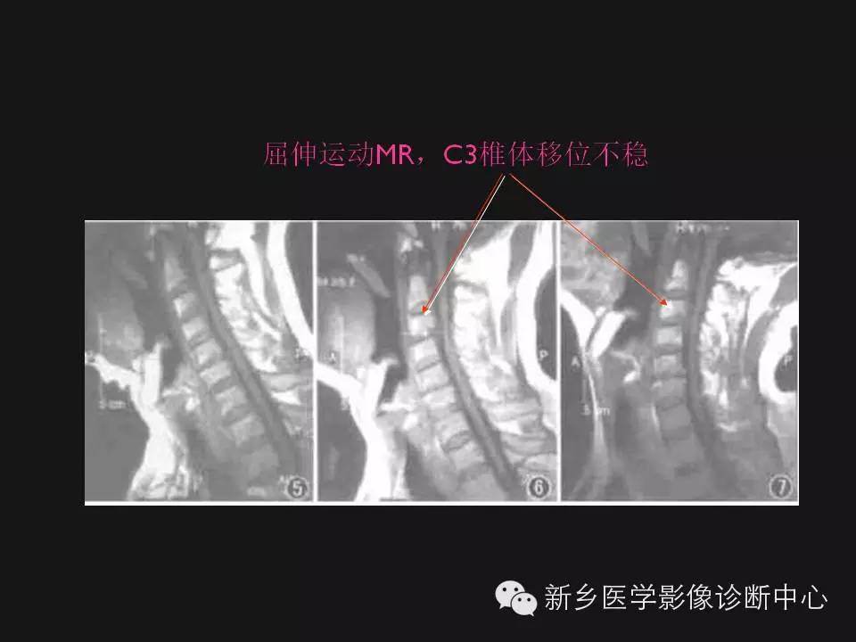 纯干货：颈椎病影像诊断重点汇总！