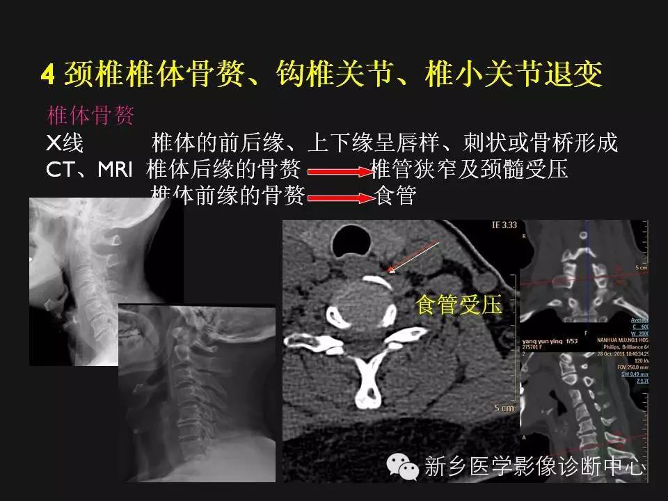 纯干货：颈椎病影像诊断重点汇总！