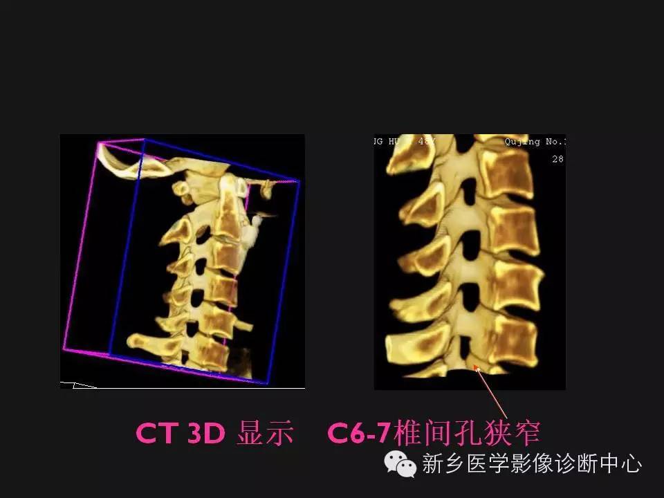 纯干货：颈椎病影像诊断重点汇总！