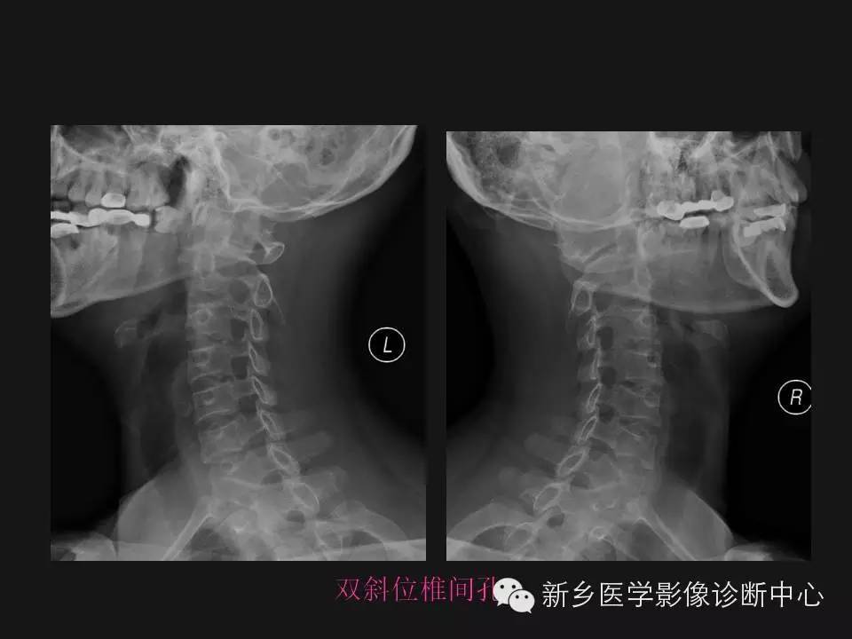 纯干货：颈椎病影像诊断重点汇总！