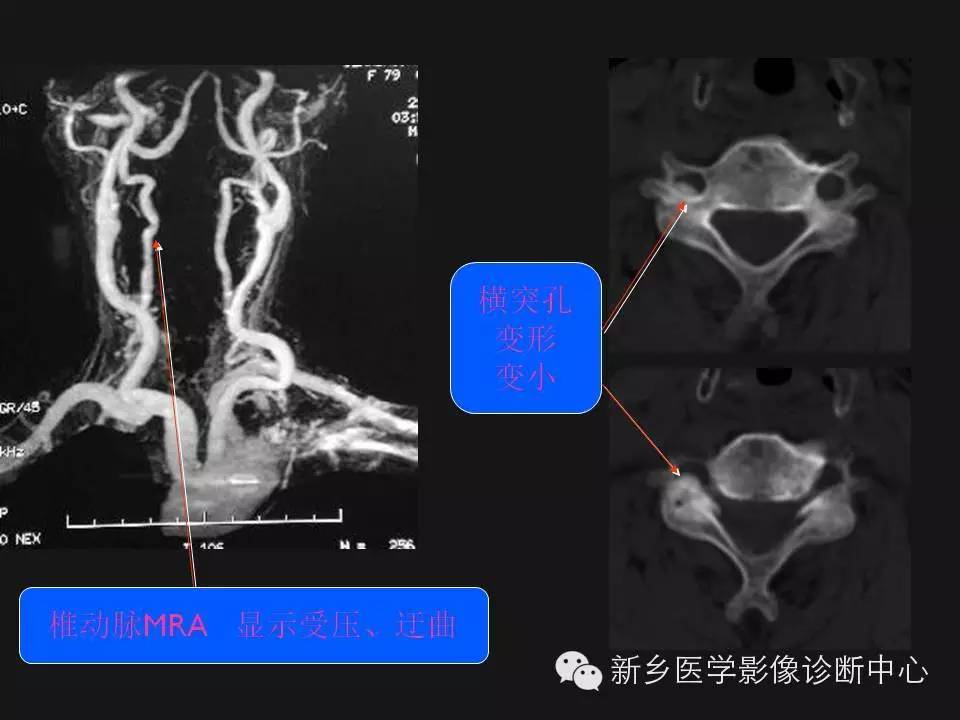 纯干货：颈椎病影像诊断重点汇总！