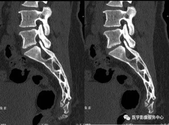 如何诊断骶尾骨骨折？这篇文章帮助你！（附病例）