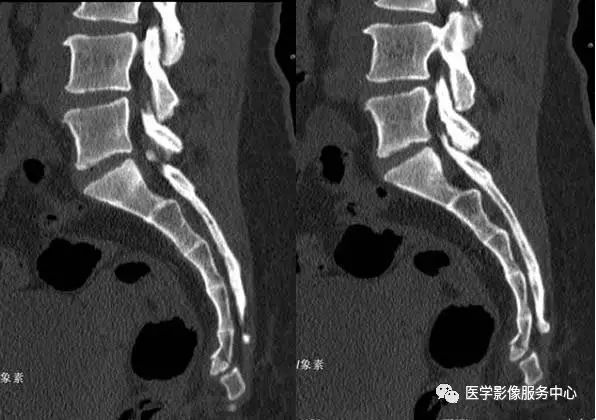 如何诊断骶尾骨骨折？这篇文章帮助你！（附病例）