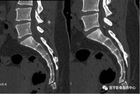 如何诊断骶尾骨骨折？这篇文章帮助你！（附病例）