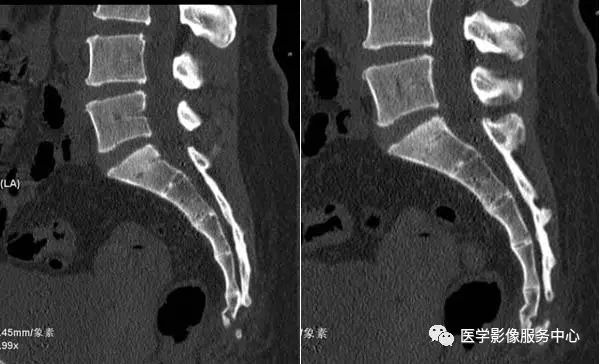 如何诊断骶尾骨骨折？这篇文章帮助你！（附病例）