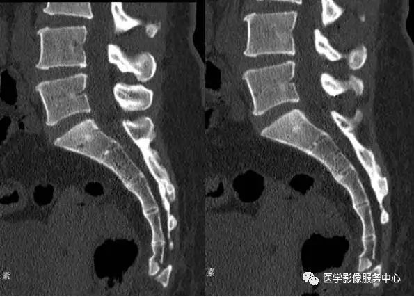 如何诊断骶尾骨骨折？这篇文章帮助你！（附病例）