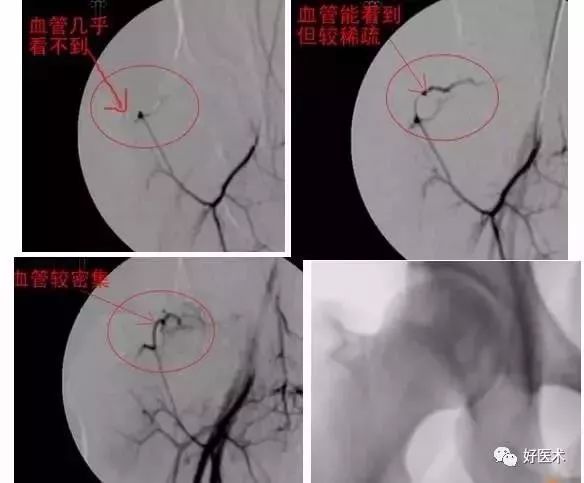 股骨头坏死的十大要点，帮你整理好了！