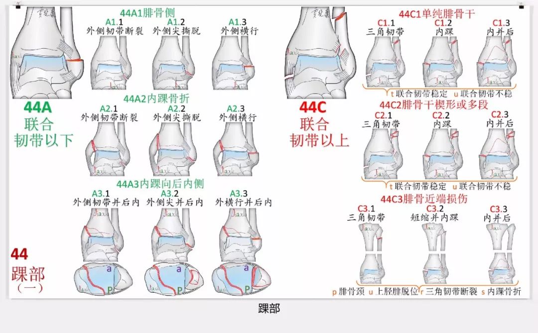 值得收藏！最全的AO骨折分型图谱