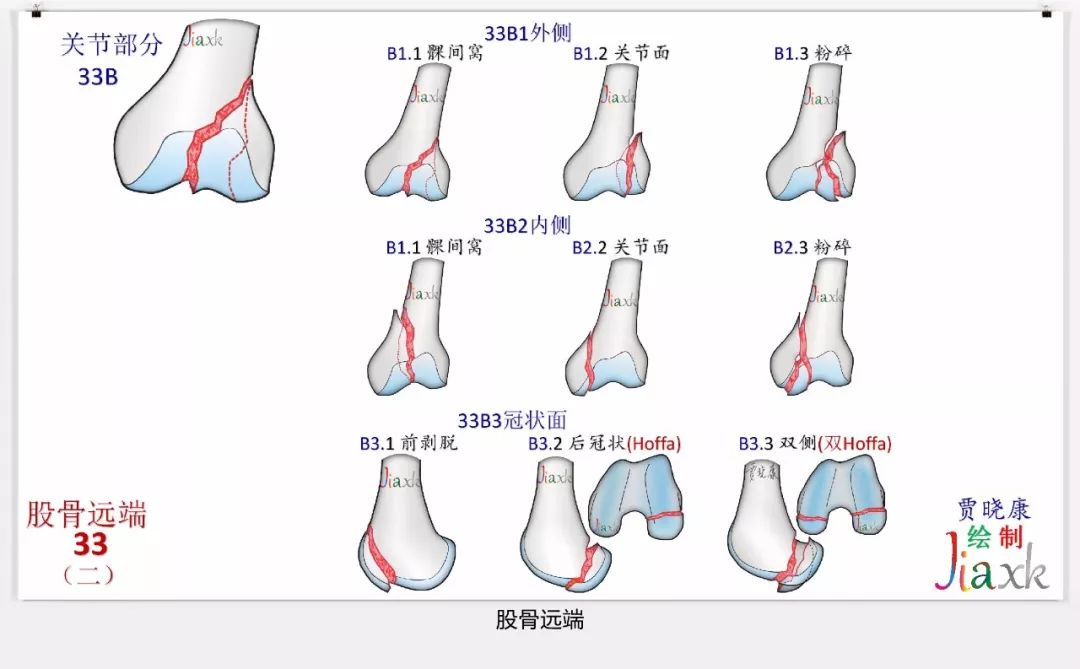 值得收藏！最全的AO骨折分型图谱