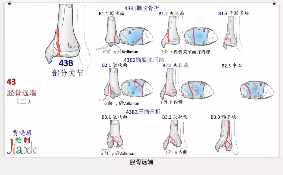 值得收藏！最全的AO骨折分型图谱