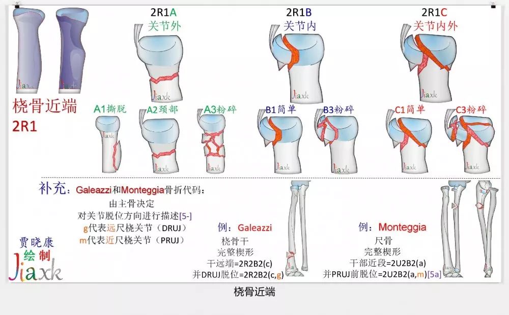 值得收藏！最全的AO骨折分型图谱