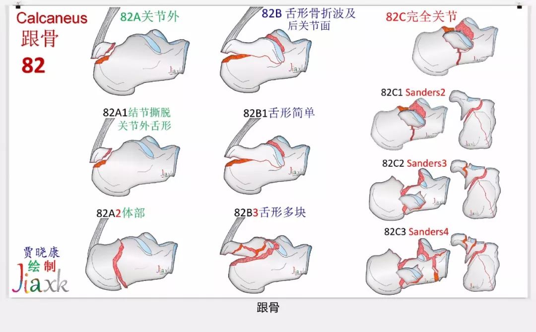 值得收藏！最全的AO骨折分型图谱