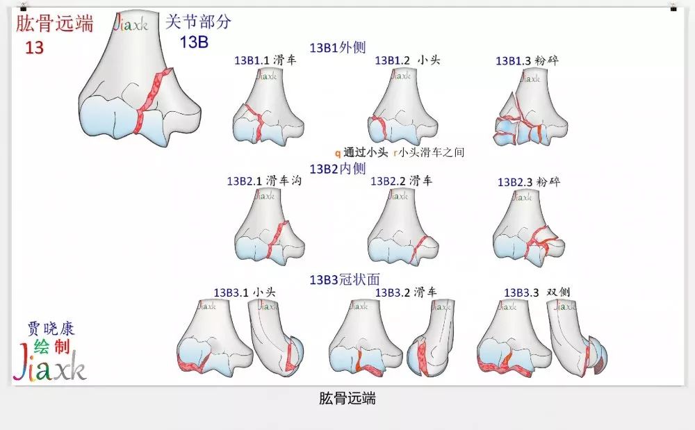 值得收藏！最全的AO骨折分型图谱