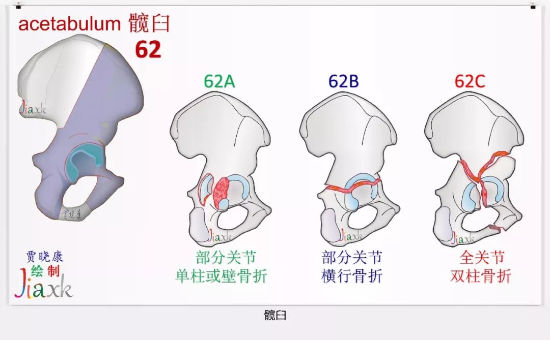 值得收藏！最全的AO骨折分型图谱