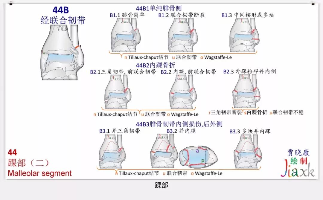 值得收藏！最全的AO骨折分型图谱