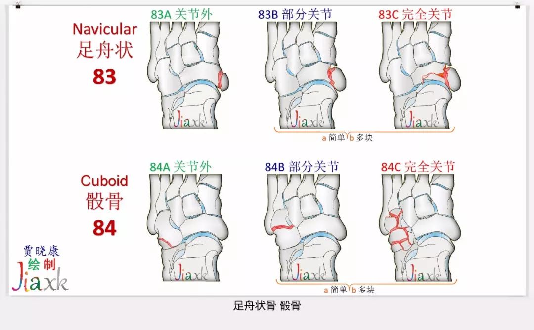 值得收藏！最全的AO骨折分型图谱