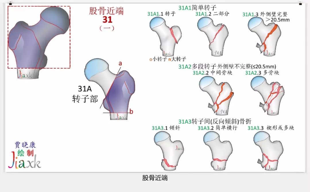 值得收藏！最全的AO骨折分型图谱