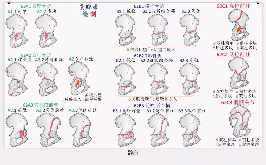 值得收藏！最全的AO骨折分型图谱