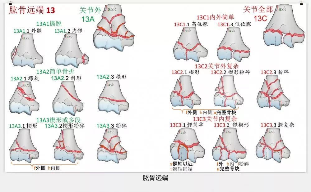 值得收藏！最全的AO骨折分型图谱