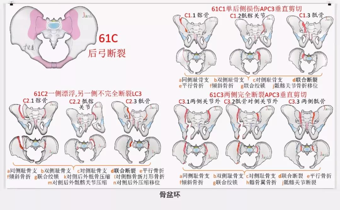 值得收藏！最全的AO骨折分型图谱