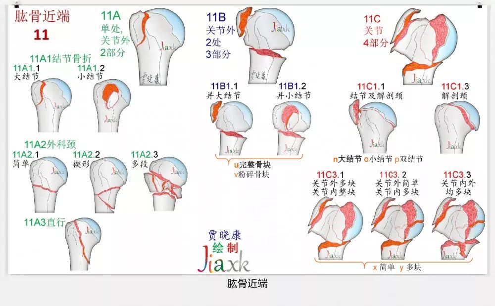 值得收藏！最全的AO骨折分型图谱