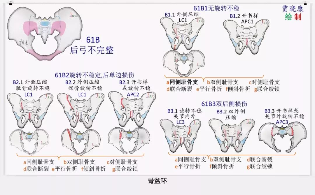 值得收藏！最全的AO骨折分型图谱