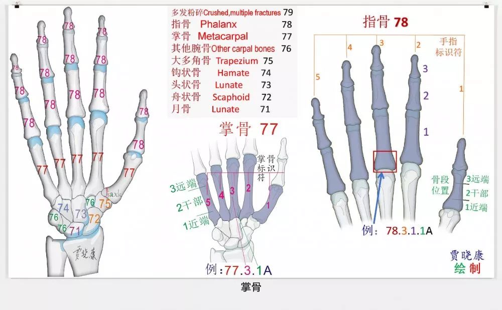 值得收藏！最全的AO骨折分型图谱