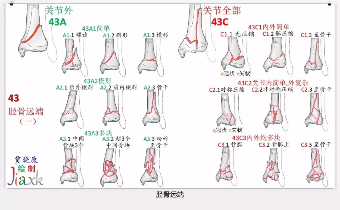 值得收藏！最全的AO骨折分型图谱