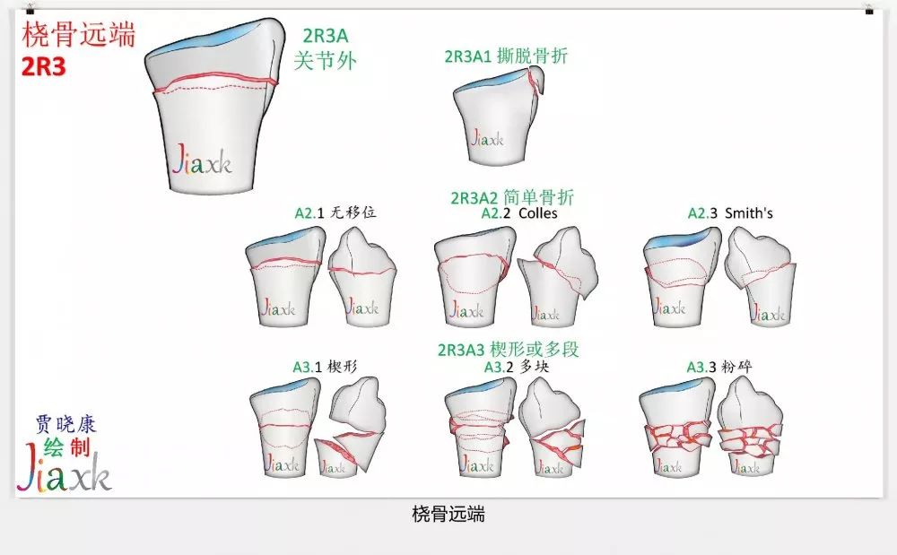 值得收藏！最全的AO骨折分型图谱