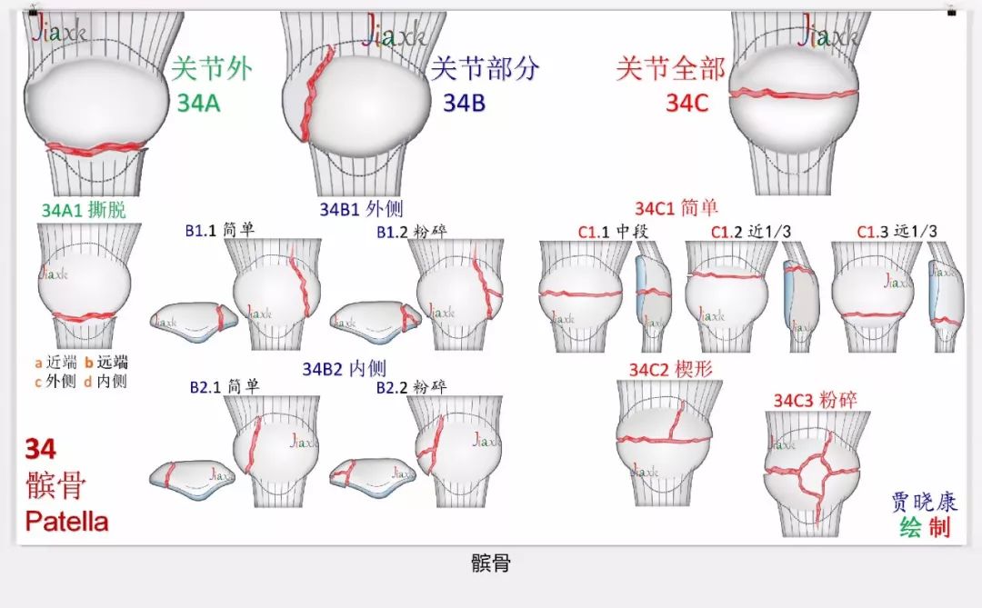 值得收藏！最全的AO骨折分型图谱