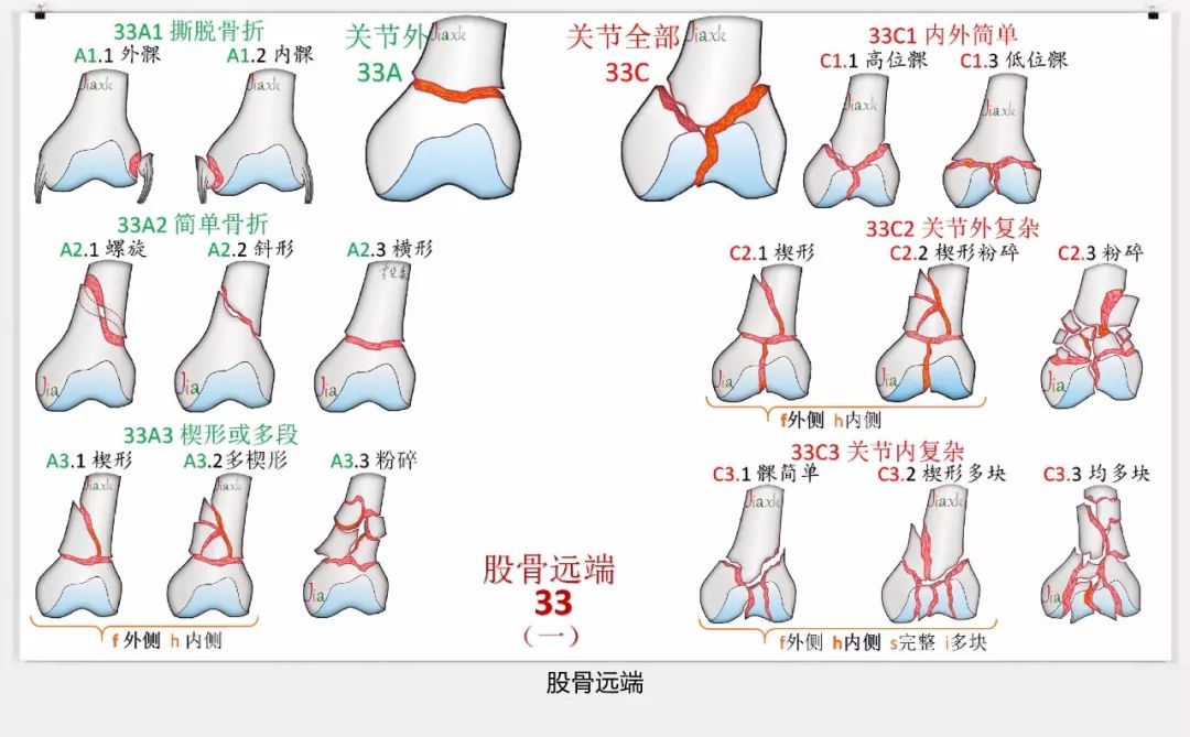 值得收藏！最全的AO骨折分型图谱