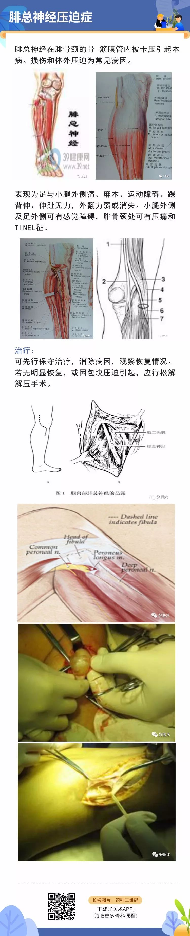 骨科常见周围神经卡压综合征，你都认识吗？
