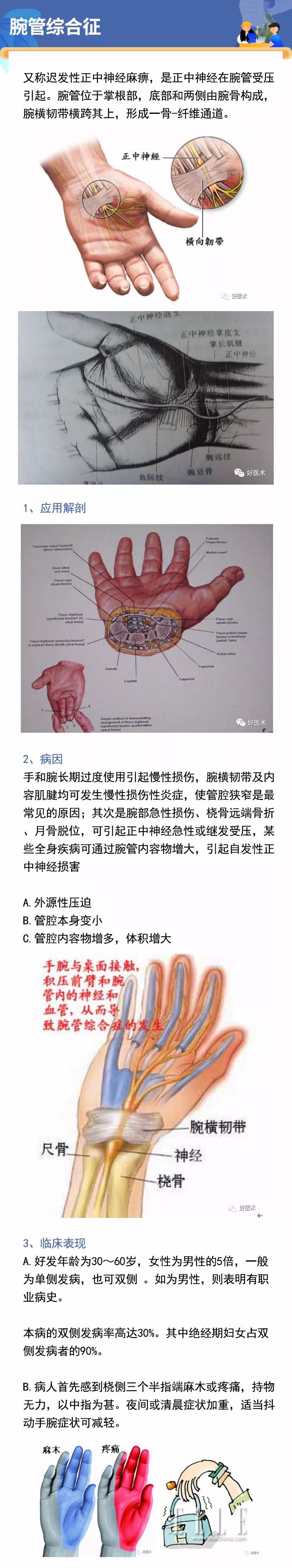 骨科常见周围神经卡压综合征，你都认识吗？