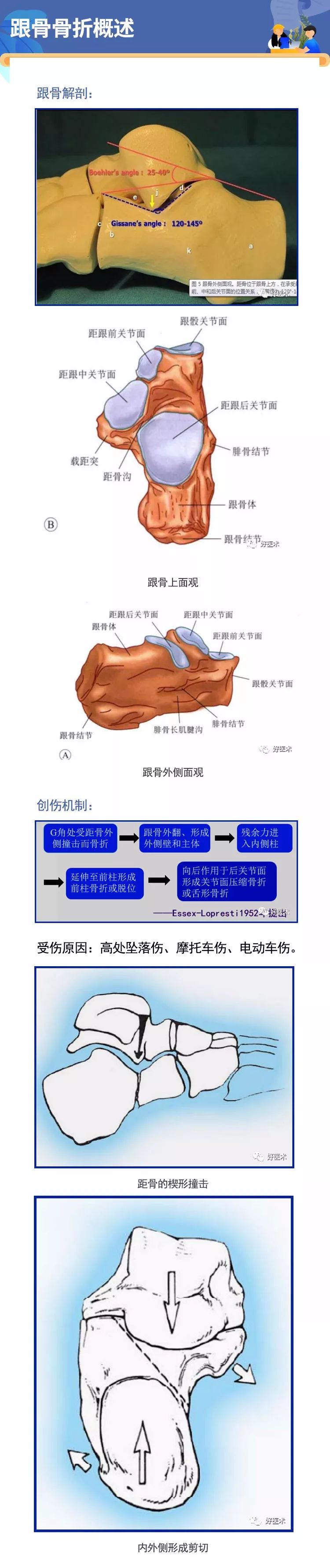 微创治疗跟骨骨折，手术技巧全解析！