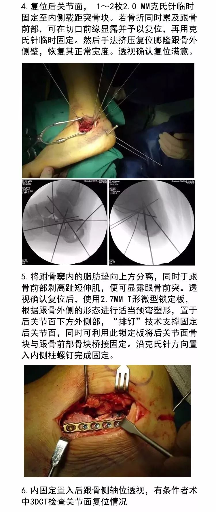 微创治疗跟骨骨折，手术技巧全解析！