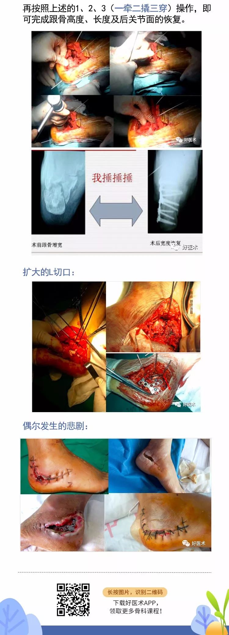 微创治疗跟骨骨折，手术技巧全解析！