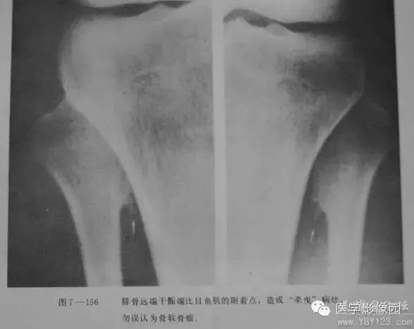 需要注意！这个“病”极易误诊为骨软骨瘤