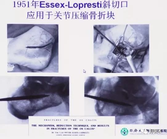 跟骨骨折如何选择手术入路及内固定？看看这篇！