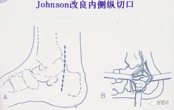 跟骨骨折如何选择手术入路及内固定？看看这篇！