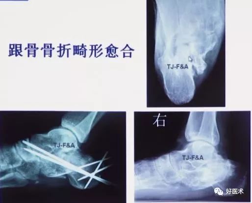 跟骨骨折如何选择手术入路及内固定？看看这篇！