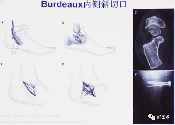 跟骨骨折如何选择手术入路及内固定？看看这篇！