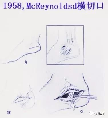 跟骨骨折如何选择手术入路及内固定？看看这篇！