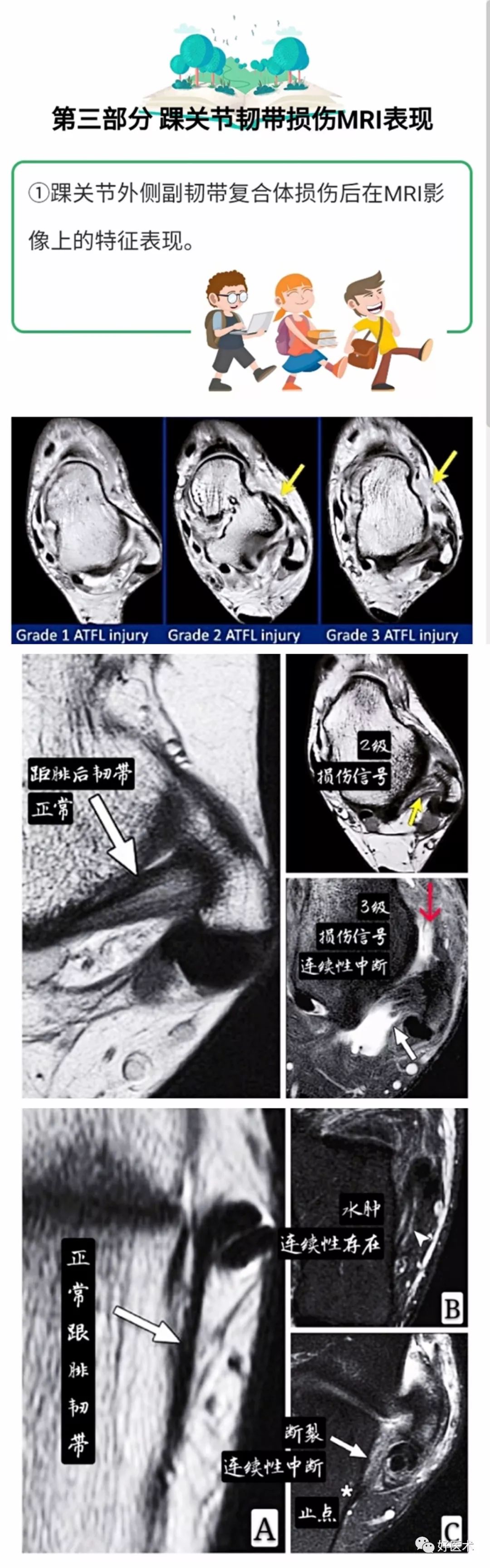 一文搞定！踝关节周围韧带的解剖及MRI特征