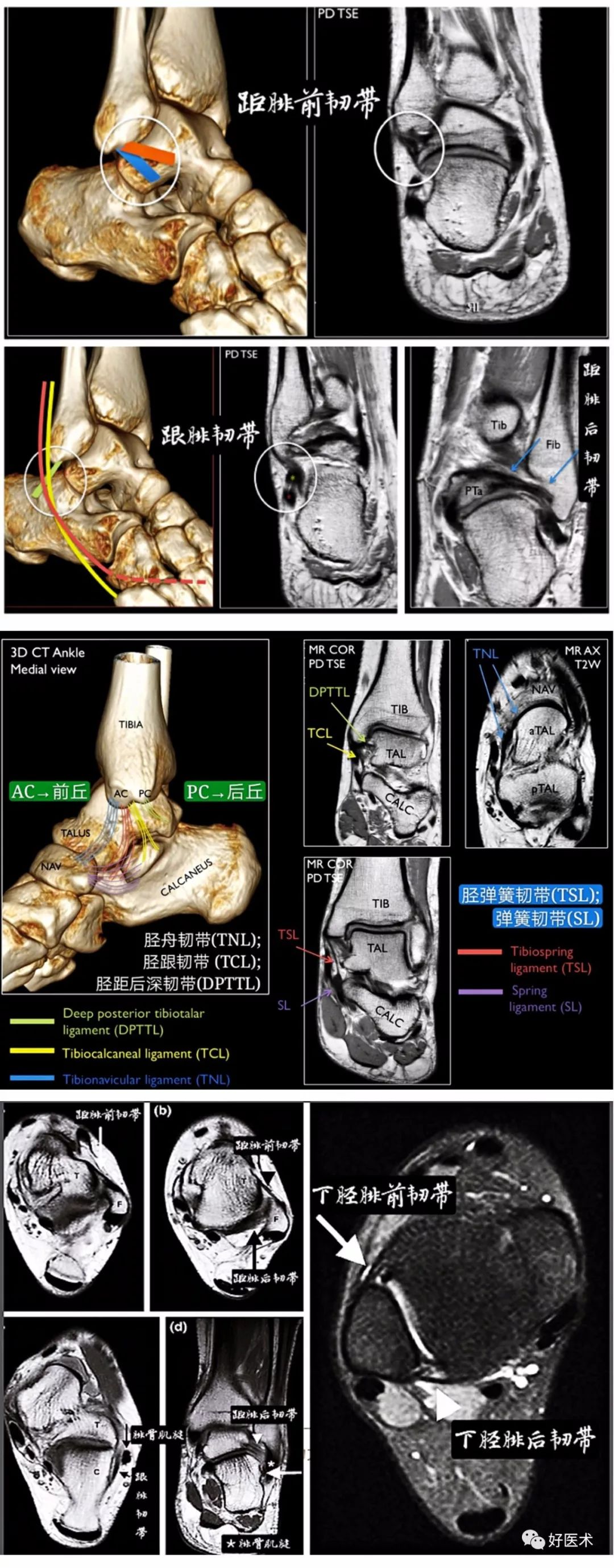 一文搞定！踝关节周围韧带的解剖及MRI特征